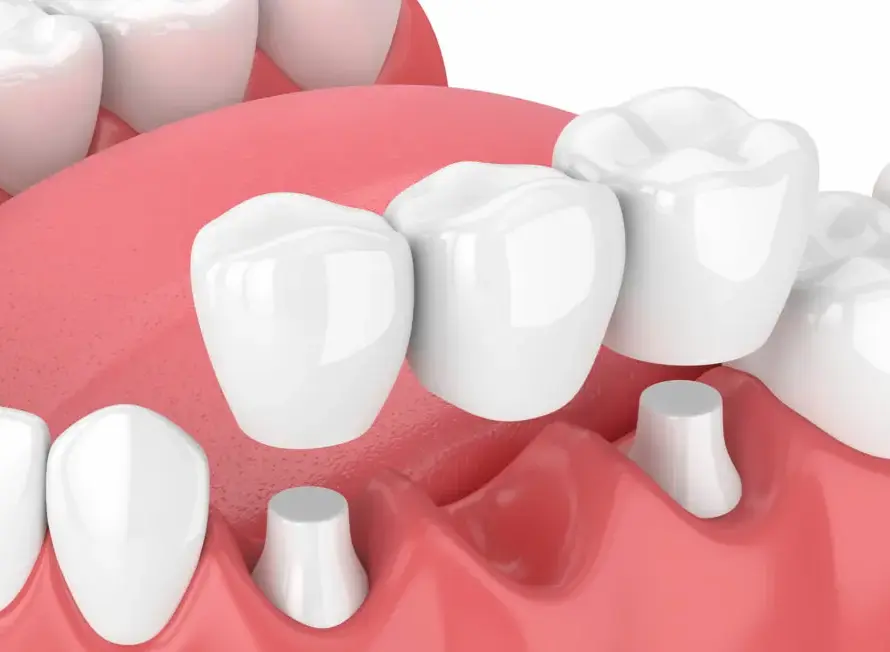 What-is-Dental-Bridge