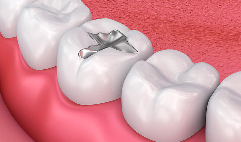 What-is-Dental-Filling-Treatment