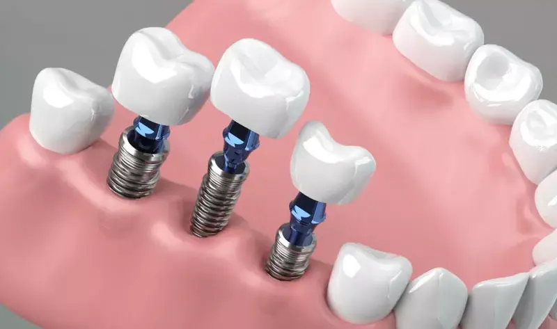 What-is-Dental-Implant-2