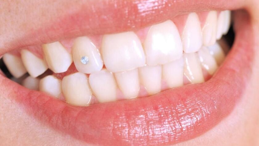 What-is-Dental-Jewellery-Grillz