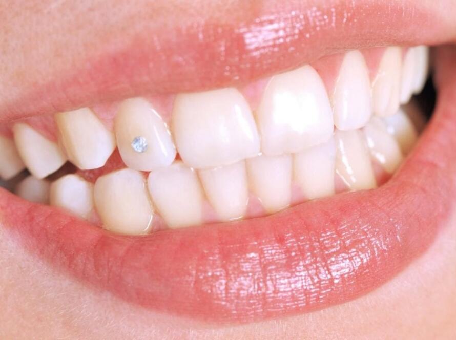 What-is-Dental-Jewellery-Grillz