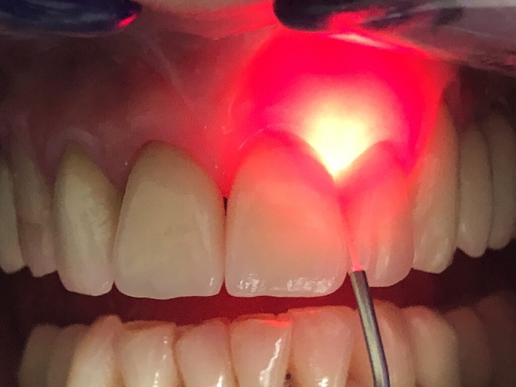 What-is-Dental-Laser-Treatment