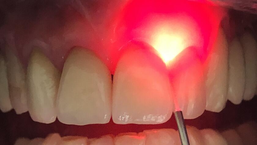 What-is-Dental-Laser-Treatment