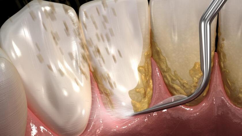 What-is-Dental-Scaling
