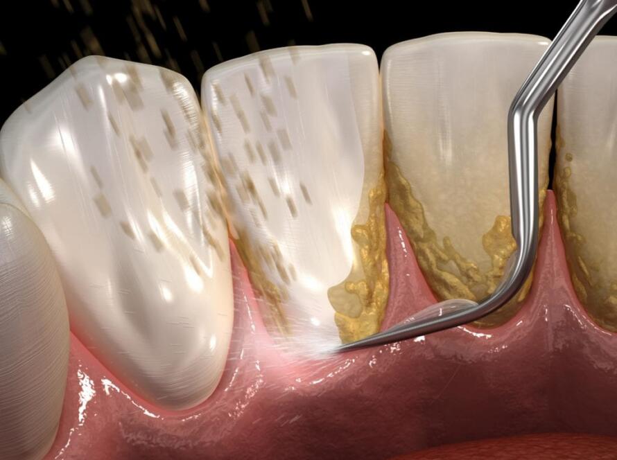 What-is-Dental-Scaling