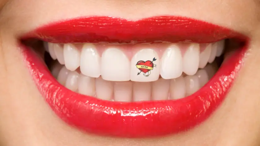 What-is-Dental-Tattoo