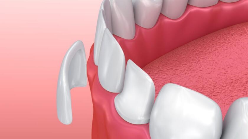 What-is-Empress-Veneer