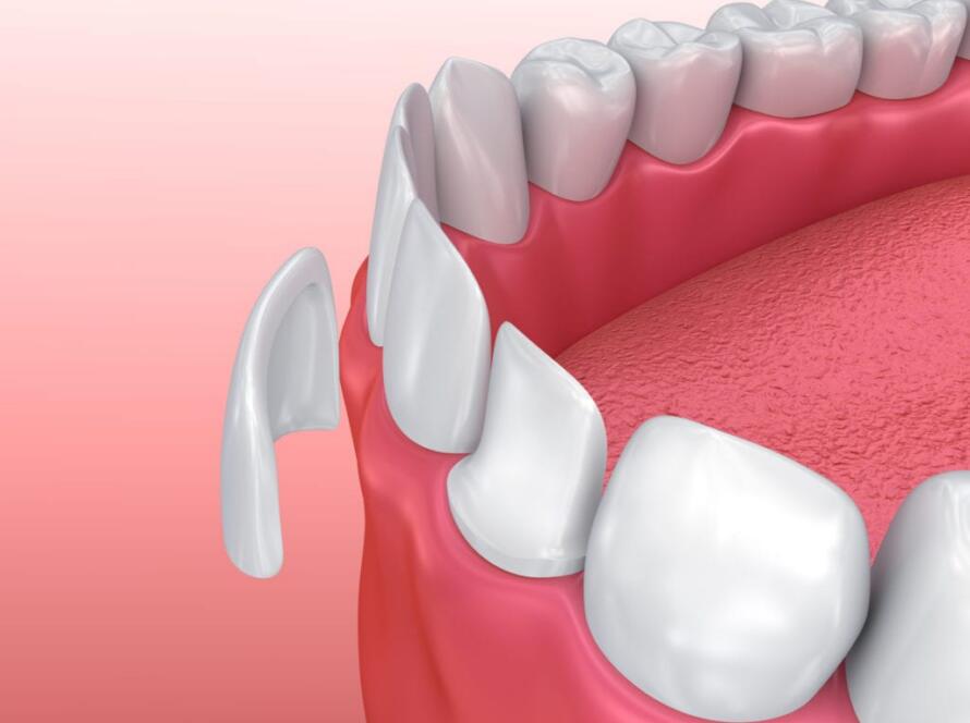 What-is-Empress-Veneer