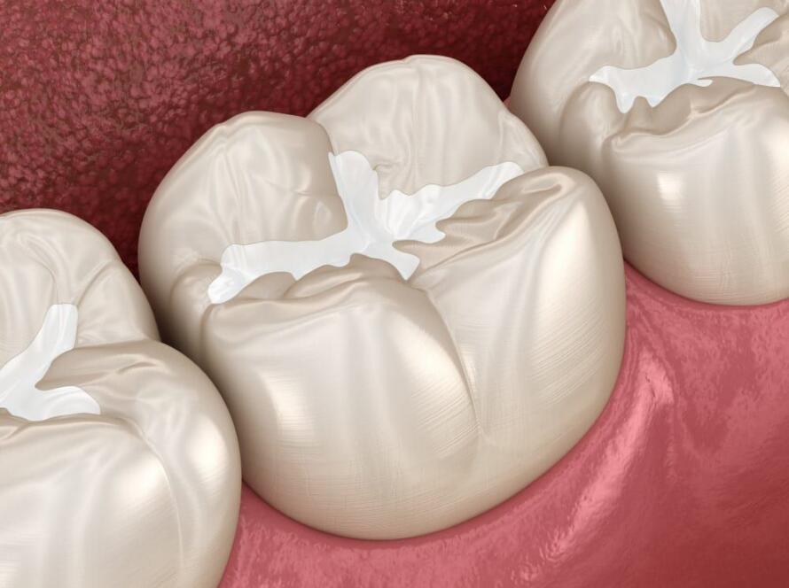 What-is-Fissure-Sealant