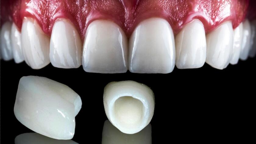 What-is-Fixed-Denture