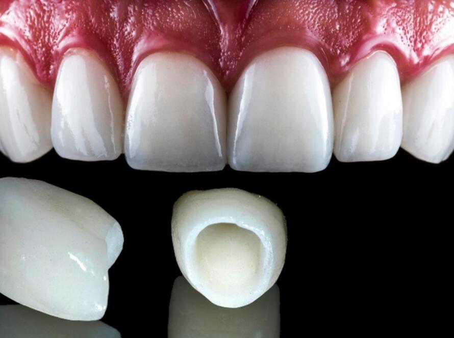 What-is-Fixed-Denture