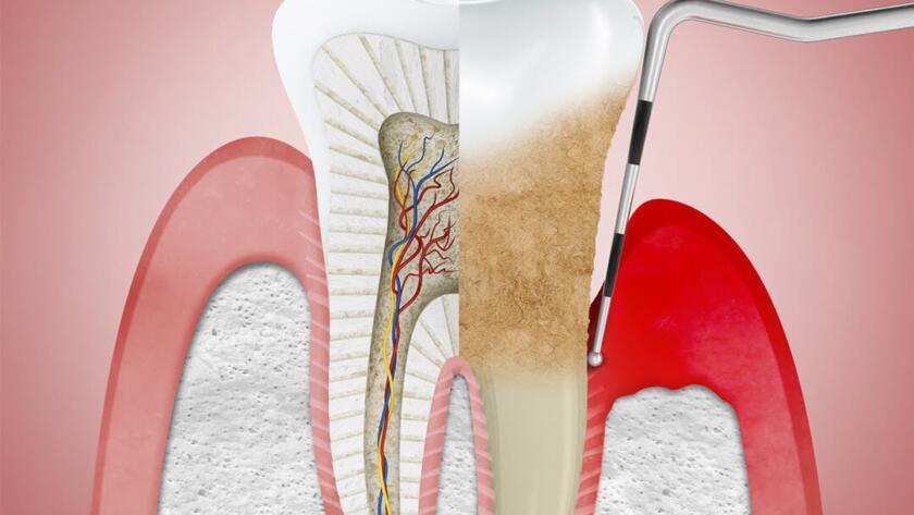 What-is-Gingival-Curettage