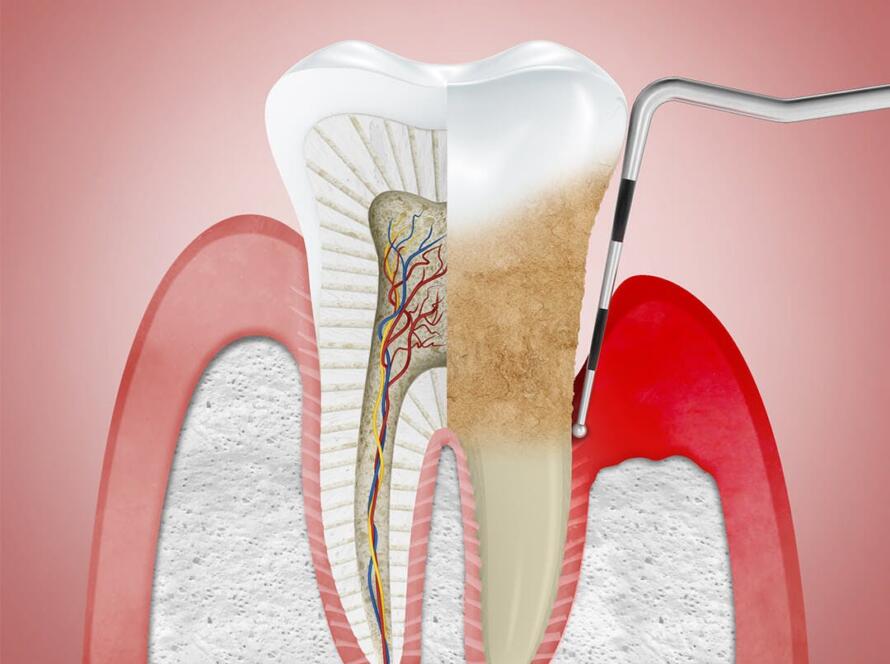 What-is-Gingival-Curettage