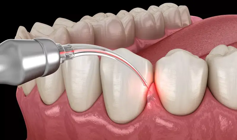 What-is-Gingival-Treatment