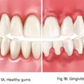 Diş Eti İltihabı – Gingivitis Nedir?