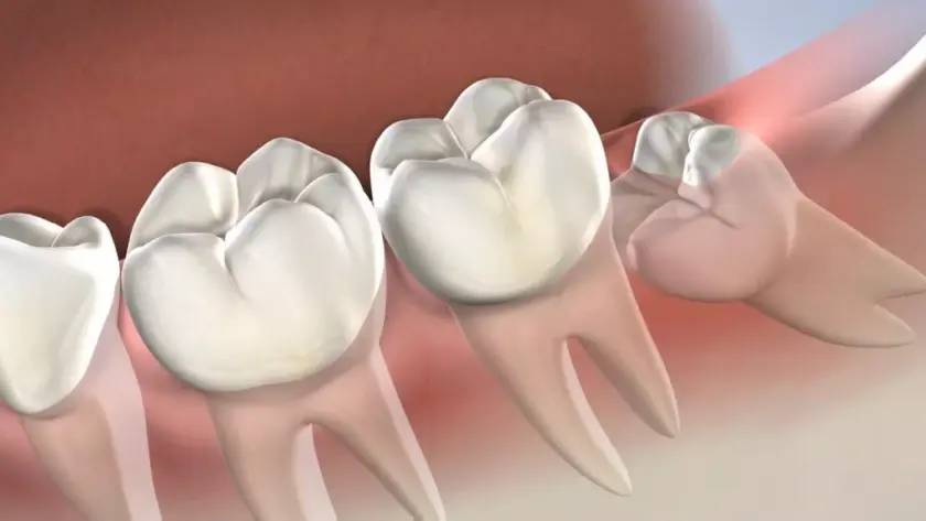 What-is-Impacted-Tooth-Treatment