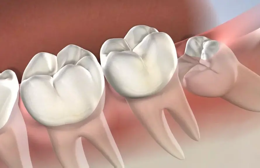 What-is-Impacted-Tooth-Treatment