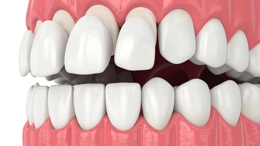 What-is-Laminated-Veneer