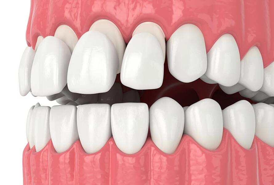 What-is-Laminated-Veneer