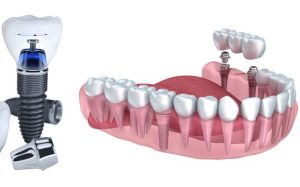 What-is-Multiple-Dental-Implant