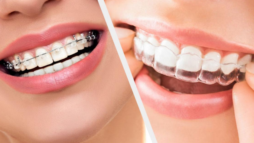 What-is-Orthodontic-Treatment