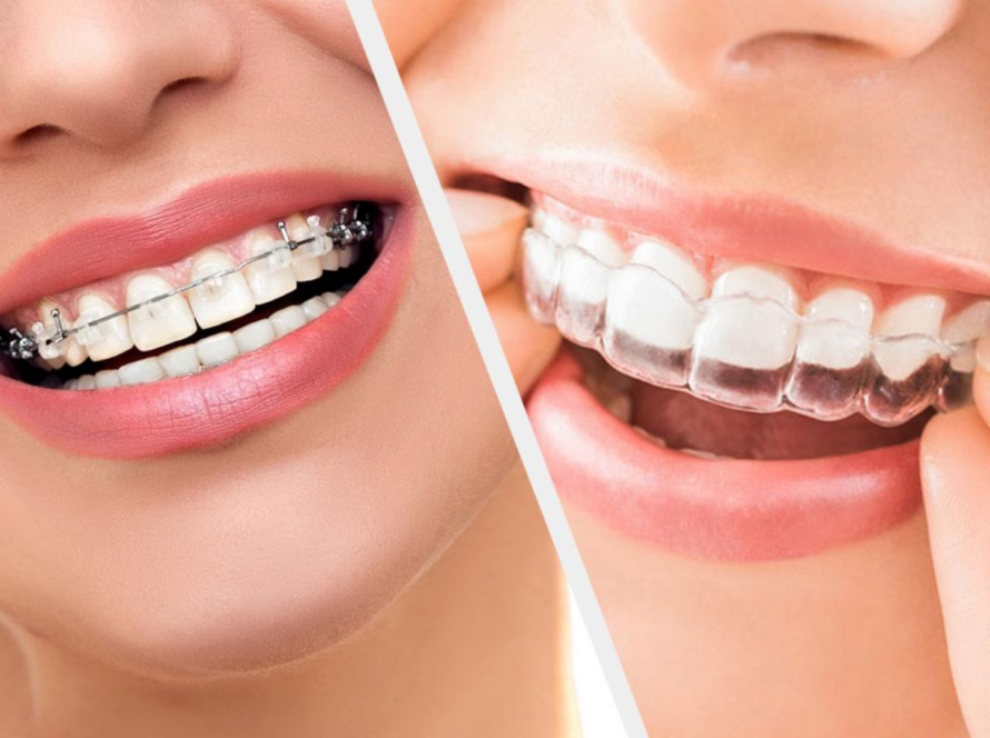 What-is-Orthodontic-Treatment