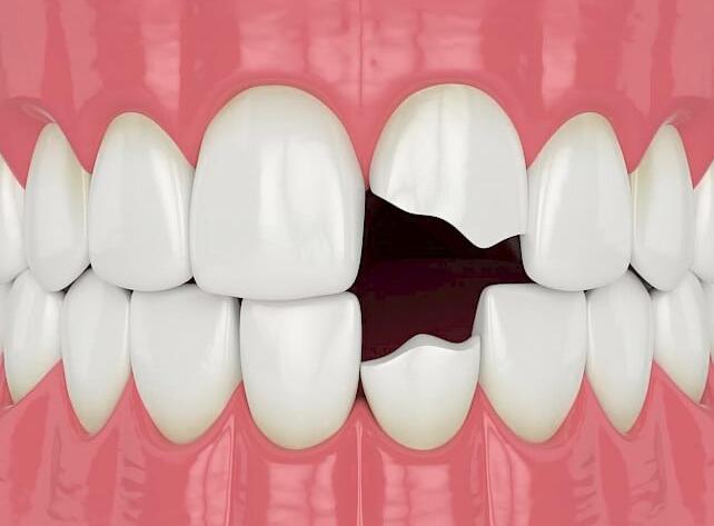 What-is-Restoration-of-Fractured-Teeth