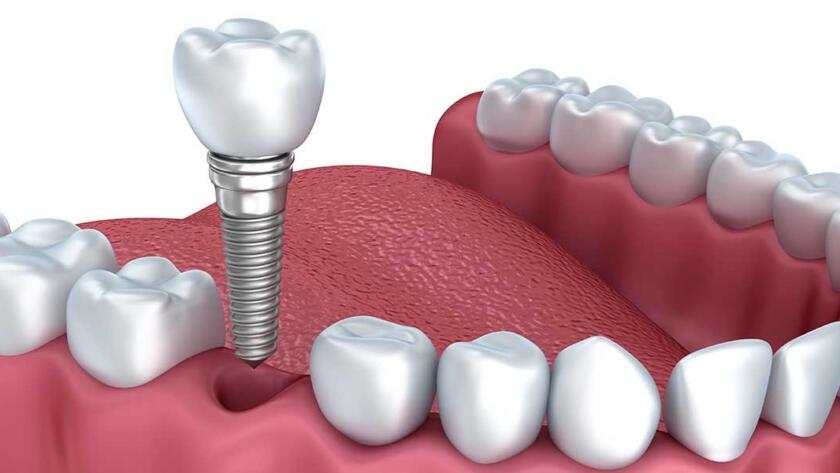 What-is-Single-Tooth-Implant-Treatment