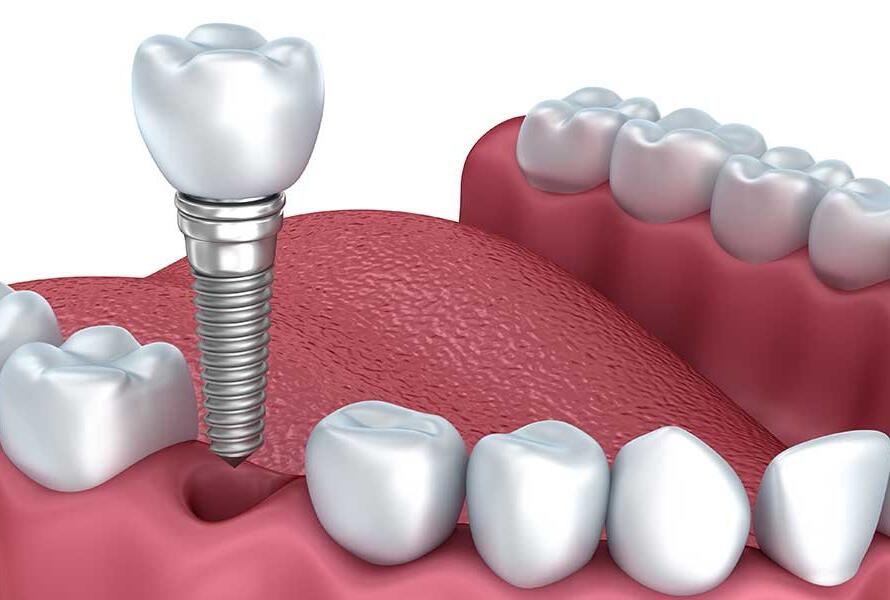 What-is-Single-Tooth-Implant-Treatment