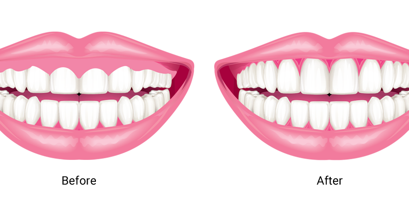 What-is-Smile-Design-3