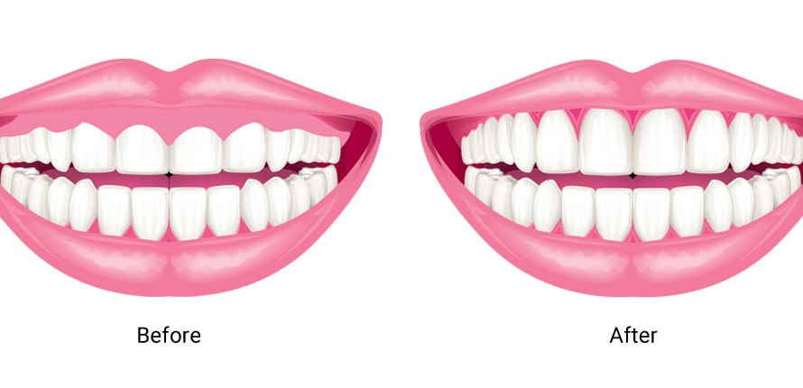 What-is-Smile-Design-3