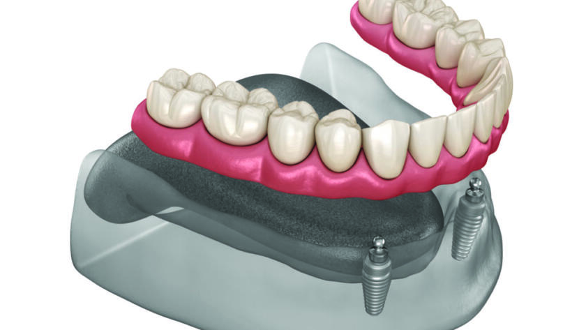 What-is-Snap-On-Denture