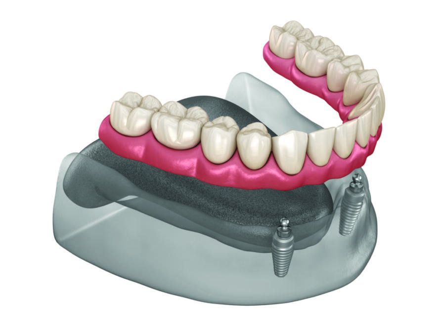 What-is-Snap-On-Denture