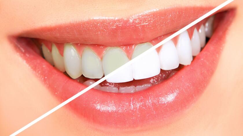 What-is-Teeth-Whitening-4