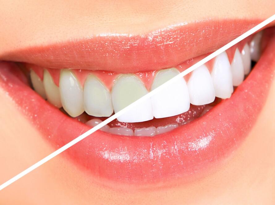 What-is-Teeth-Whitening-4