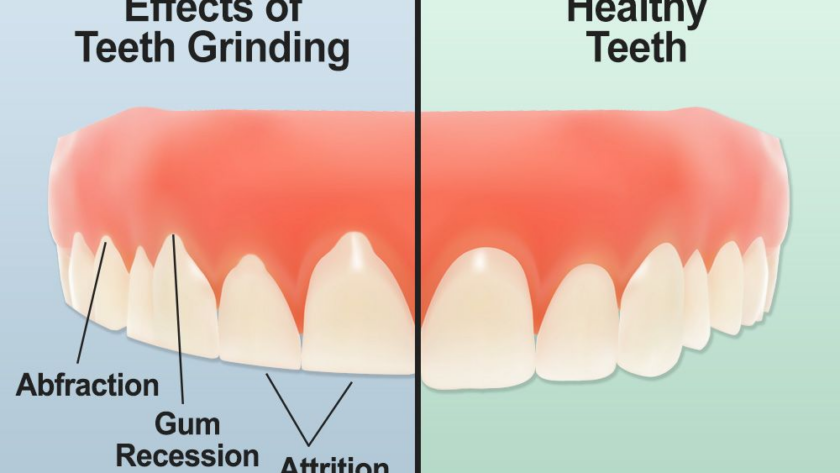What-is-tooth-grinding-bruxism