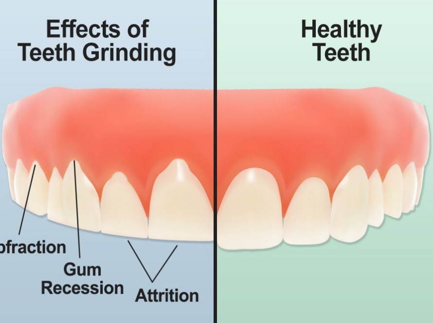 What-is-tooth-grinding-bruxism