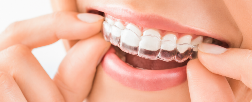 What-is-Transparent-Aligner-or-Invisalign-Treatment
