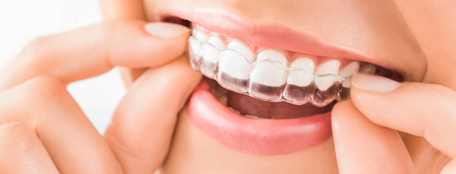 What-is-Transparent-Aligner-or-Invisalign-Treatment