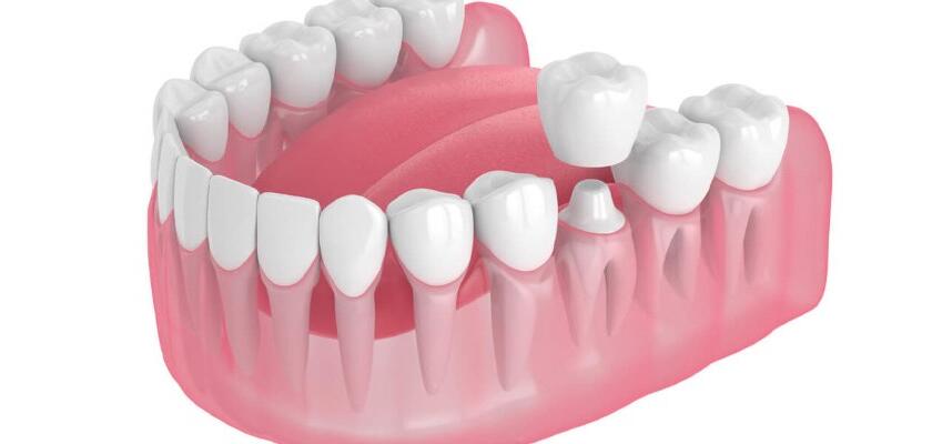What-is-Zirconia-Tooth