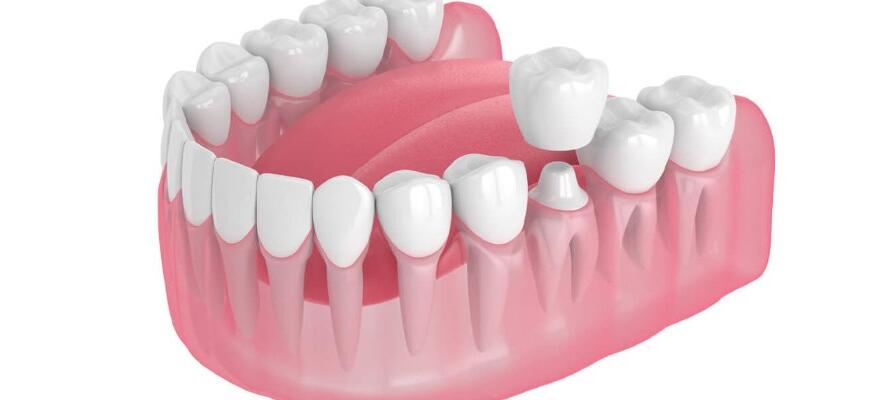 What-is-Zirconia-Tooth