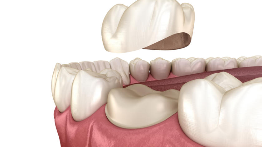 What-is-Zirconia-Veneer