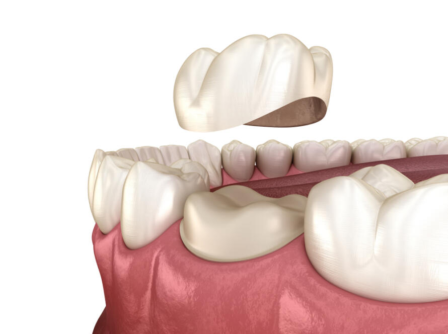 What-is-Zirconia-Veneer