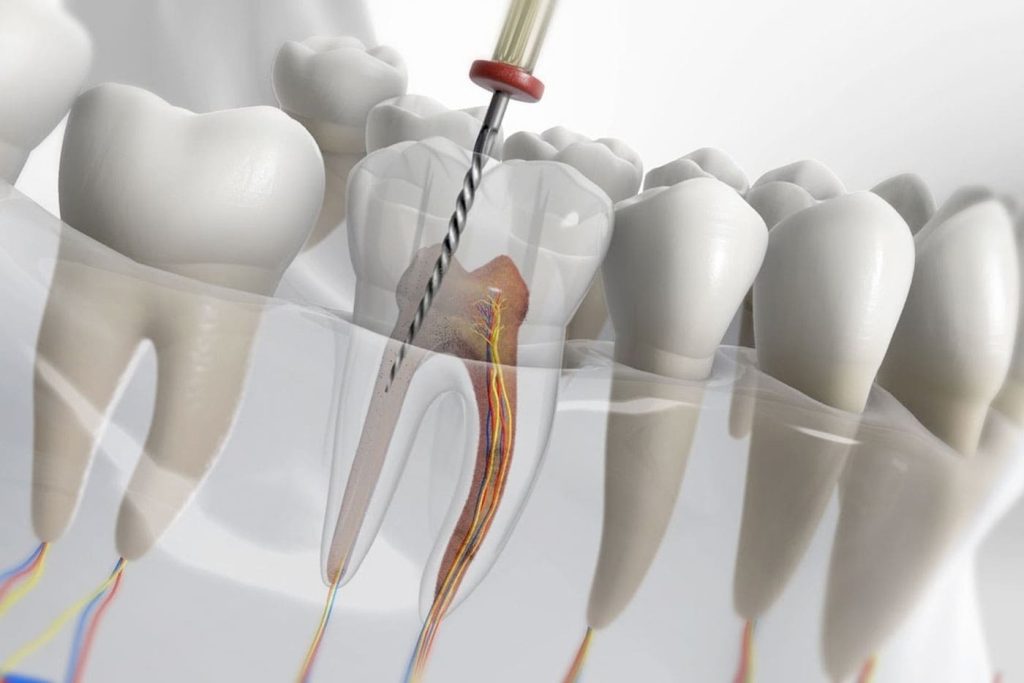 Root canal treatment at Antalya Smile Designs Dental Clinic.