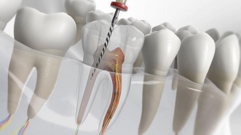 Root canal treatment at Antalya Smile Designs Dental Clinic.
