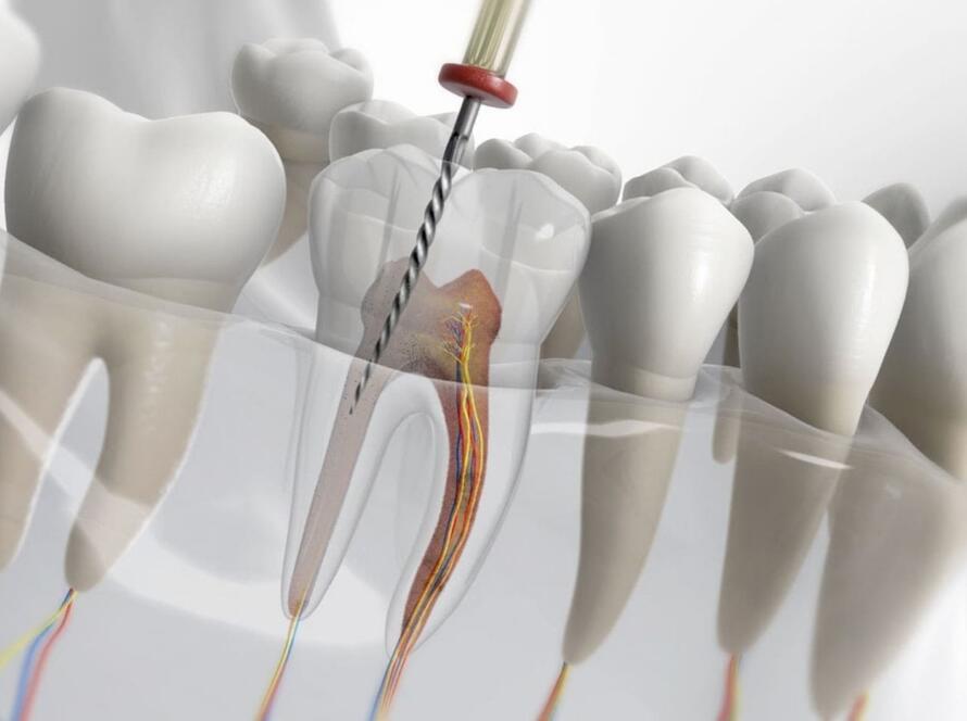 Root canal treatment at Antalya Smile Designs Dental Clinic.