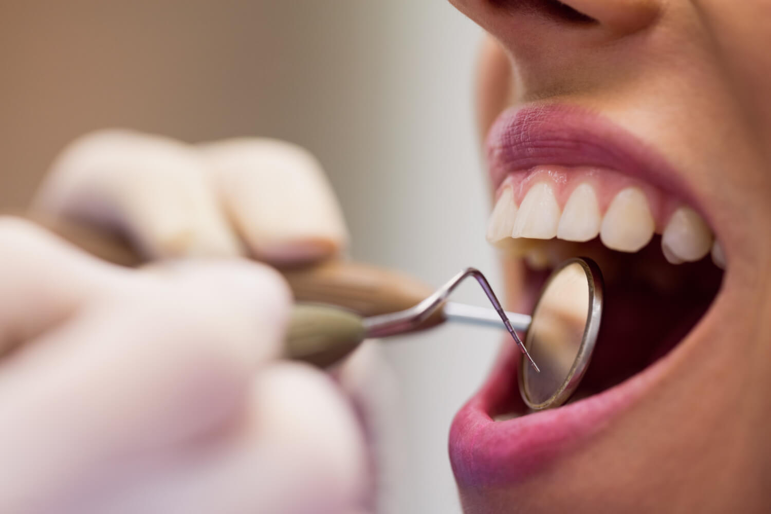 Comparison of Zirconium and E-Max veneers at Antalya Smile Designs Dental Clinic