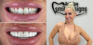 Smile design at Antalya Smile Designs Dental Clinic in Turkey.