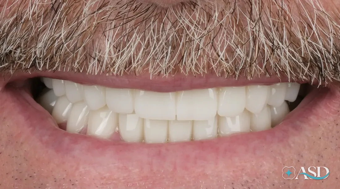 Bridges case 2, after treatment