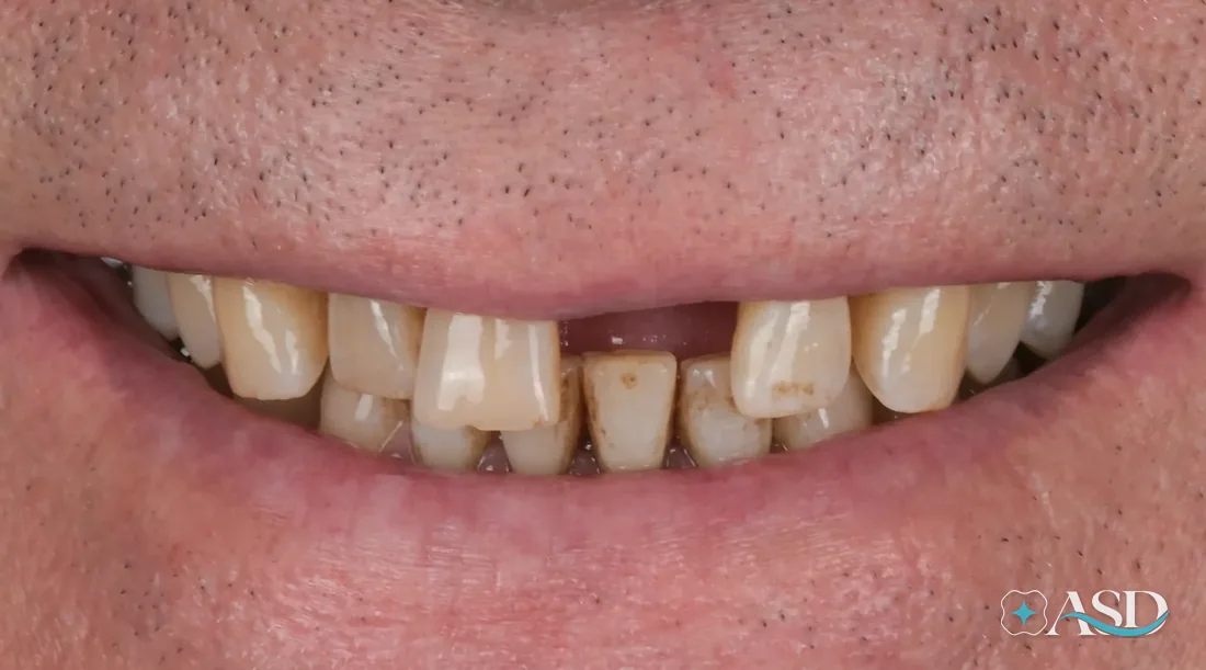 Bridges case 2, before treatment